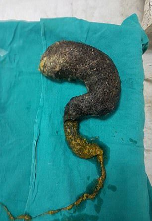 из девушки извлекли комок волос, занимавший 80% желудка