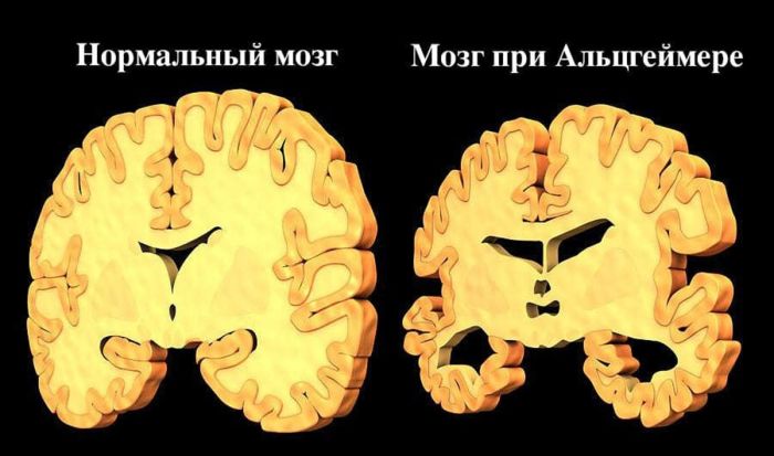 Как заранее определить одну из самых медленно развивающихся болезней Как заранее определить одну из самых медленно развивающихся болезней native-yes