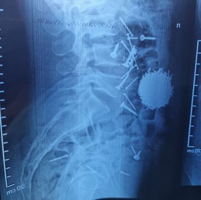 Невероятная история из Узбекистана: 200 граммов гвоздей и саморезов извлечены из желудка мужчины