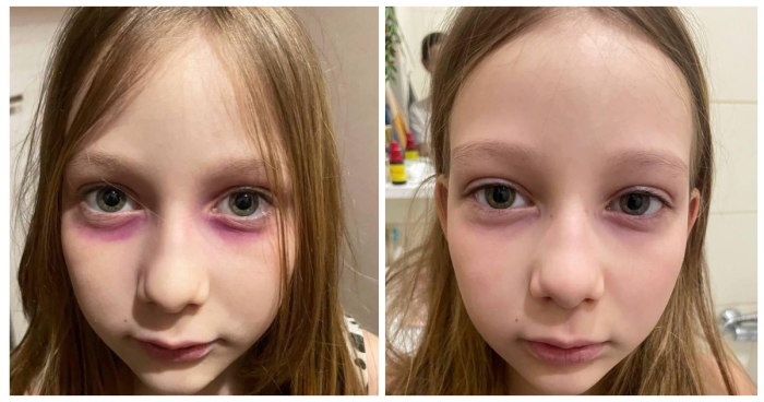 картинка 4c13552c10 mat nedelju lechila 10 letnjuju doch ot redkoj bolezni kotoruju ta narisovala sebe pod glazami 2